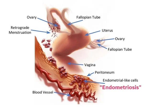 endometriosis explanation picture
